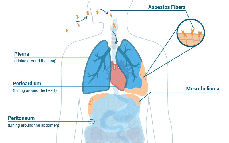 The Most Common Symptoms of Mesothelioma