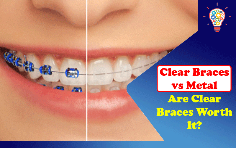 Clear Braces vs Metal: Are Clear Braces Worth It?