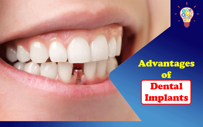 Dental Implants