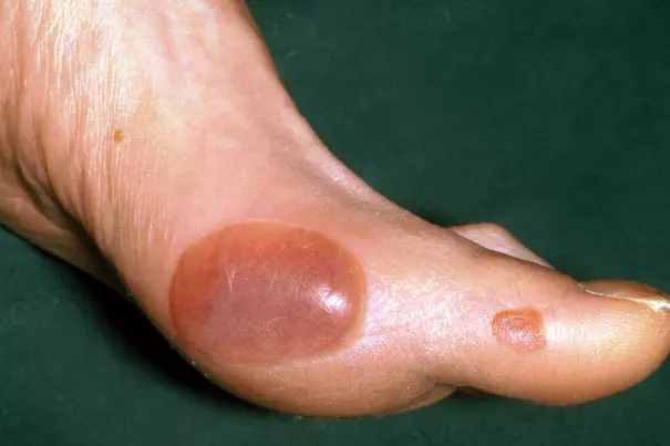 Diabetic Blisters