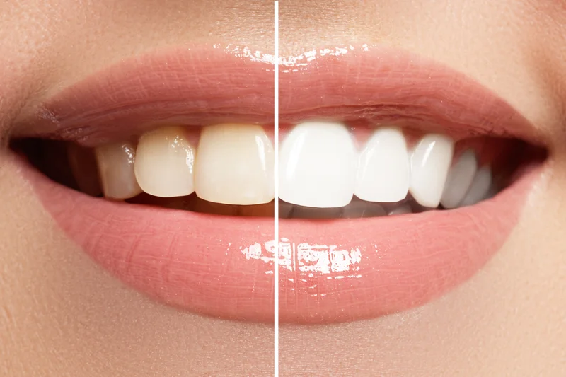 Best Ways to Whiten Teeth